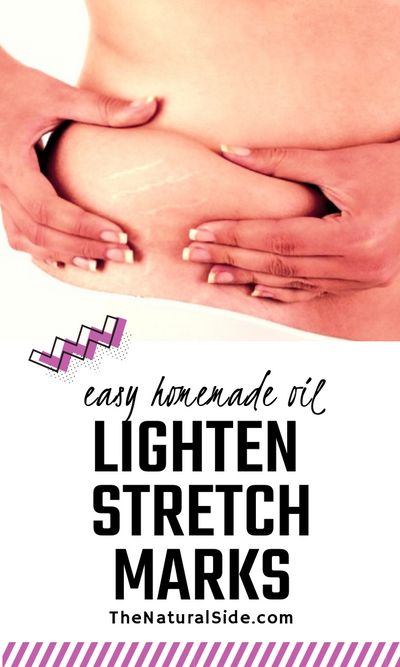 There are many different home remedies to get rid of stretch marks. Here you will find a simple homemade remedy to remove stretch marks naturally at home. Beauty tips an ddiy beauty via thenaturalside.com #beauty #homeremedies #skincare
